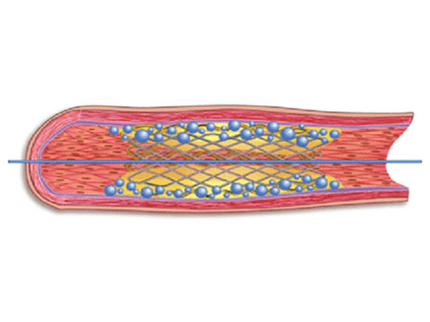 Stent Ring Blasa